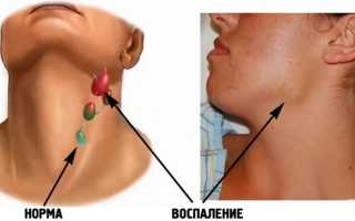 Воспаление лимфоузлов и связь с щитовидной железой