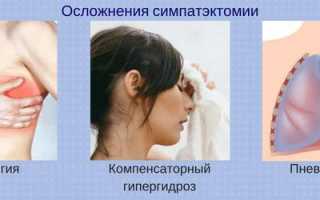 Симпатэктомия от повышенной потливости