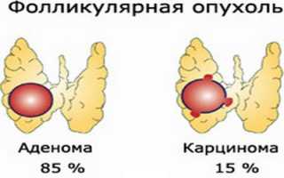 Фолликулярная аденома щитовидной железы