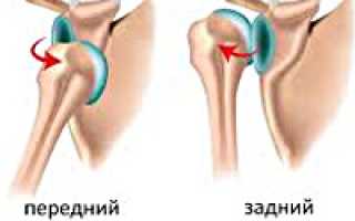 Перелом большого бугорка плечевой кости