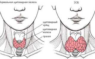 Зоб 1 степени щитовидной железы