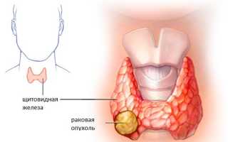 Фолликулярная неоплазия щитовидной железы описание заболевания
