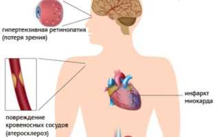 2 степень гипертонии: симптомы и лечение