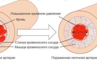 Профилактика и лечение легочной гипертензии