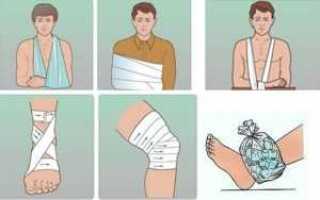 Оказание первой помощи при вывихах