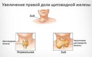 Правая доля щитовидной железы