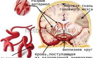 Последствия геморрагического инсульта и методы восстановления после него